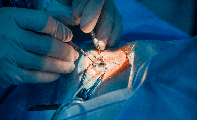 Cirugía para reparación o reconstrucción de Iris en Monterrey: Innovación en Oftalmología